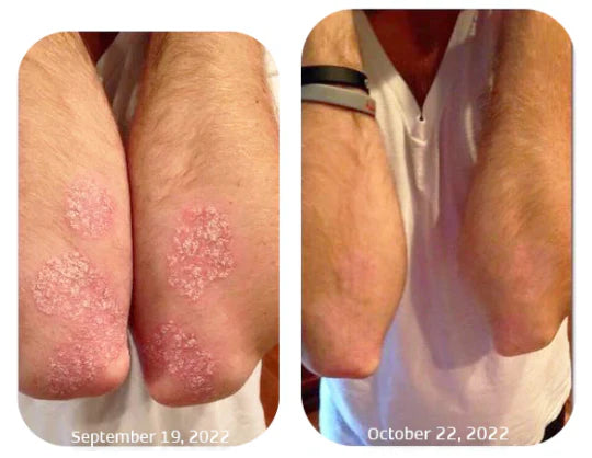 Spray Kolmax™ – Alivio rápido para piel irritada, seca o escamosa